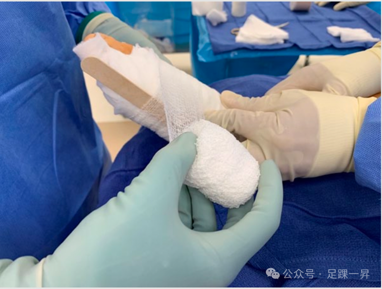 压舌板用纱布怎么包拇外翻｜术后压舌板敷料包扎技术_https://www.jmylbn.com_新闻资讯_第8张