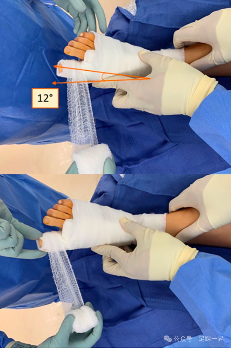 压舌板用纱布怎么包拇外翻｜术后压舌板敷料包扎技术_https://www.jmylbn.com_新闻资讯_第10张