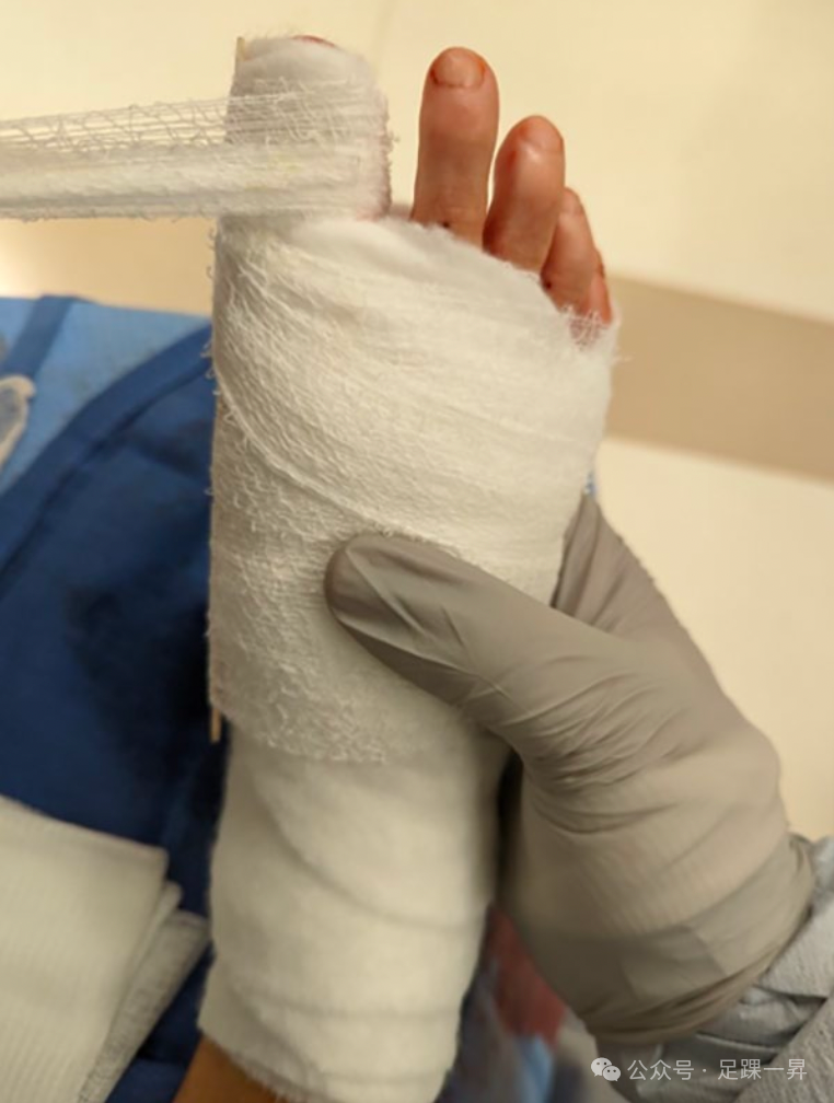 压舌板用纱布怎么包拇外翻｜术后压舌板敷料包扎技术_https://www.jmylbn.com_新闻资讯_第9张