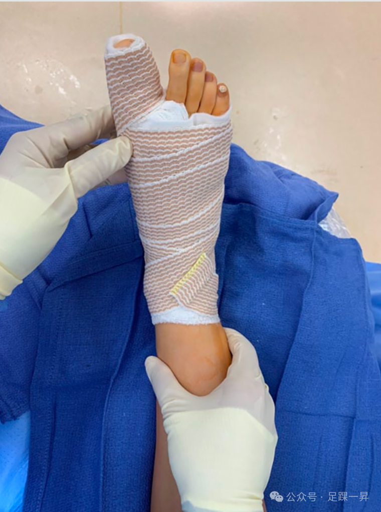 压舌板用纱布怎么包拇外翻｜术后压舌板敷料包扎技术_https://www.jmylbn.com_新闻资讯_第11张