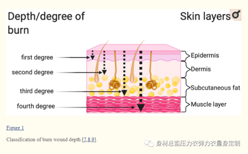 医疗敷料是什么烧伤创面愈合：临床并发症、医疗护理、治疗和敷料类型 身材总监烧烫伤压力衣定制-上海聚慕医疗器械有限公司