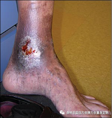 医用夹板怎么软化烧伤患者避免走弯路必读！！！烧伤康复指南--物理治疗、职业治疗、烧伤疤痕挛缩、烧伤压力衣弹力衣定制_https://www.jmylbn.com_新闻资讯_第11张