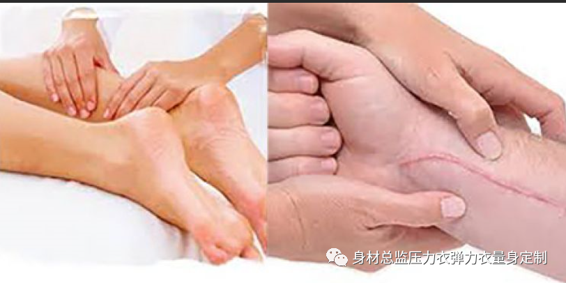 医用夹板怎么软化烧伤患者避免走弯路必读！！！烧伤康复指南--物理治疗、职业治疗、烧伤疤痕挛缩、烧伤压力衣弹力衣定制_https://www.jmylbn.com_新闻资讯_第20张