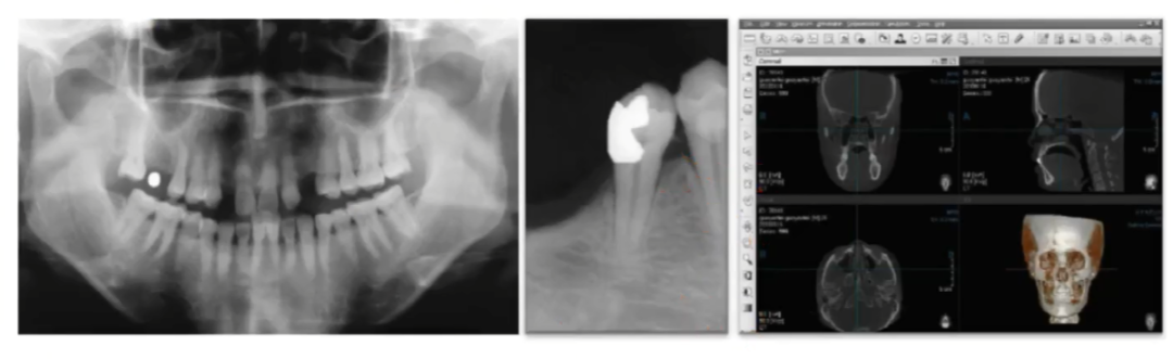 曲面断层片怎么看种植术前读片，学会看CBCT、曲断片、根尖片_https://www.jmylbn.com_新闻资讯_第2张