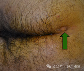 索诺星超声怎么样骶尾部藏毛窦广东（广州）索诺星无线掌超现场试机活动，无线掌超，值得拥有_https://www.jmylbn.com_新闻资讯_第4张