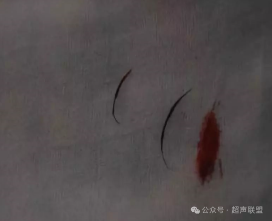 索诺星超声怎么样骶尾部藏毛窦广东（广州）索诺星无线掌超现场试机活动，无线掌超，值得拥有_https://www.jmylbn.com_新闻资讯_第2张