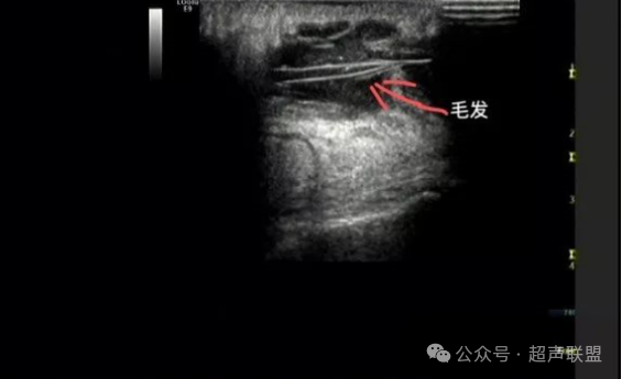 索诺星超声怎么样骶尾部藏毛窦广东（广州）索诺星无线掌超现场试机活动，无线掌超，值得拥有_https://www.jmylbn.com_新闻资讯_第3张