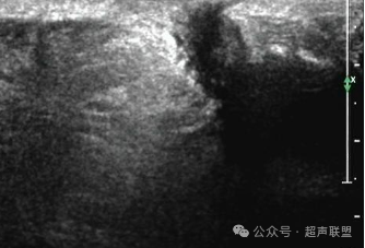 索诺星超声怎么样骶尾部藏毛窦广东（广州）索诺星无线掌超现场试机活动，无线掌超，值得拥有_https://www.jmylbn.com_新闻资讯_第6张