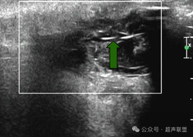 索诺星超声怎么样骶尾部藏毛窦广东（广州）索诺星无线掌超现场试机活动，无线掌超，值得拥有_https://www.jmylbn.com_新闻资讯_第5张