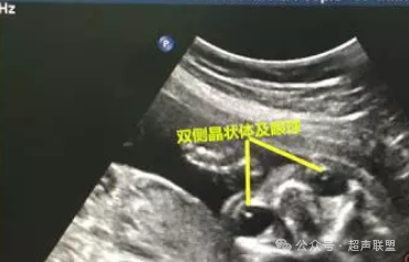 索诺星超声怎么样第五节.双眼眶切面广州索诺星无线掌超_https://www.jmylbn.com_新闻资讯_第3张