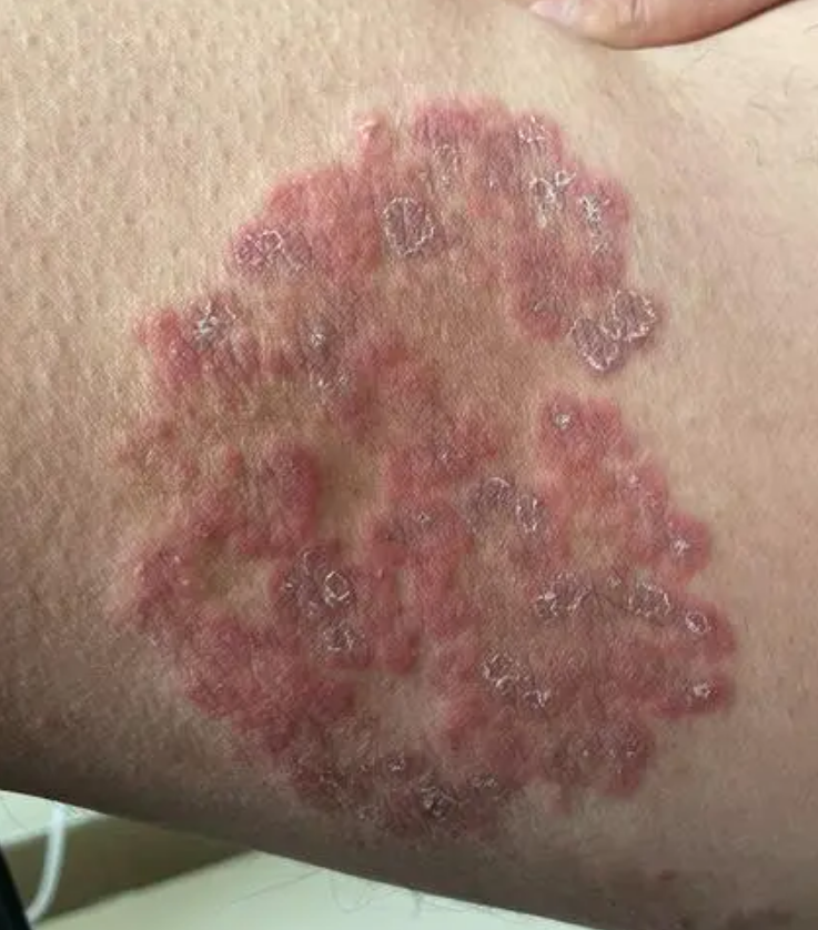 大腿两边各一片红色的“极其瘙痒”股癣怎么治疗可以除根，三个应对措施供你选