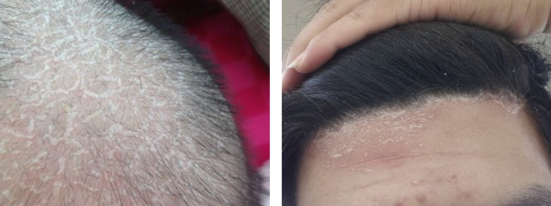 癣会痒吗？头癣的初期症状图片~9张儿童头癣真实照片