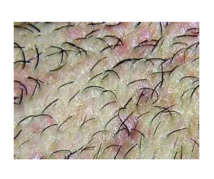 阴处毛囊炎怎么治“私密处”毛囊炎红肿硬包能不能自己处理？