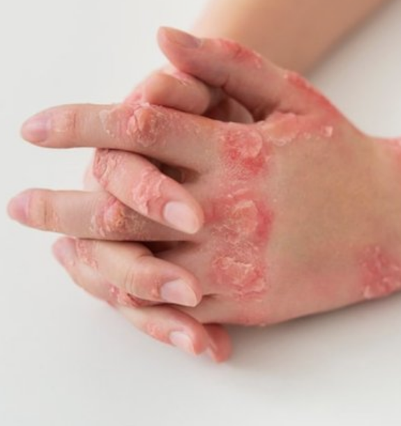 手臂上各种皮肤病对照图~手上皮肤病症状大全{手部的皮肤病参考症状}
