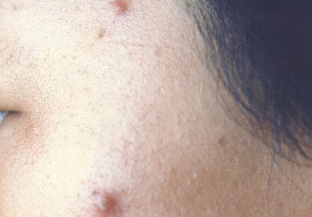 毛囊炎硬疙瘩怎么消除，消除毛囊炎硬疙瘩不再是梦，实用技巧大揭秘