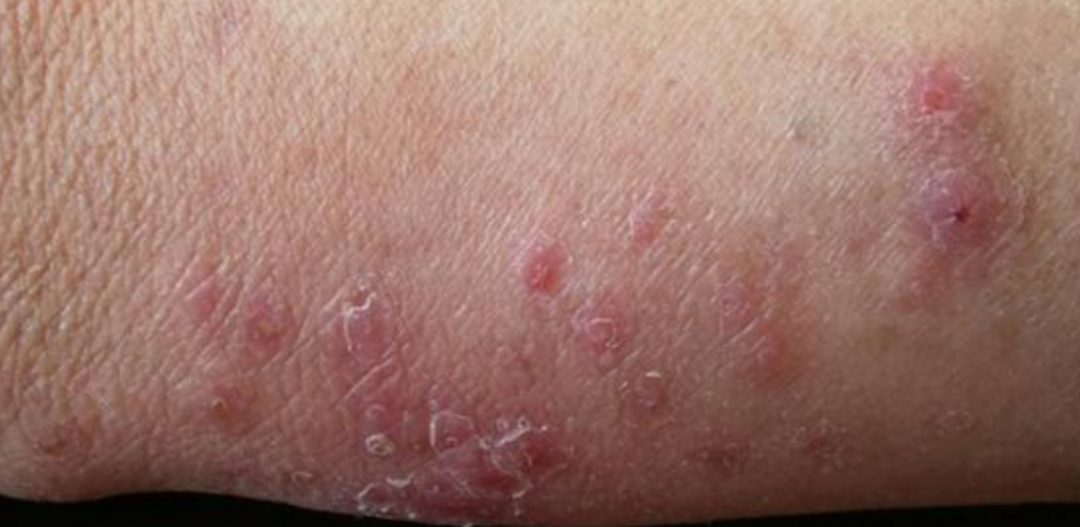 体癣·手癣·甲癣·面癣·头癣·脚癣·股癣·胡须癣·花斑癣·黑癣·牛皮癣，各种皮肤癣图片症状大全