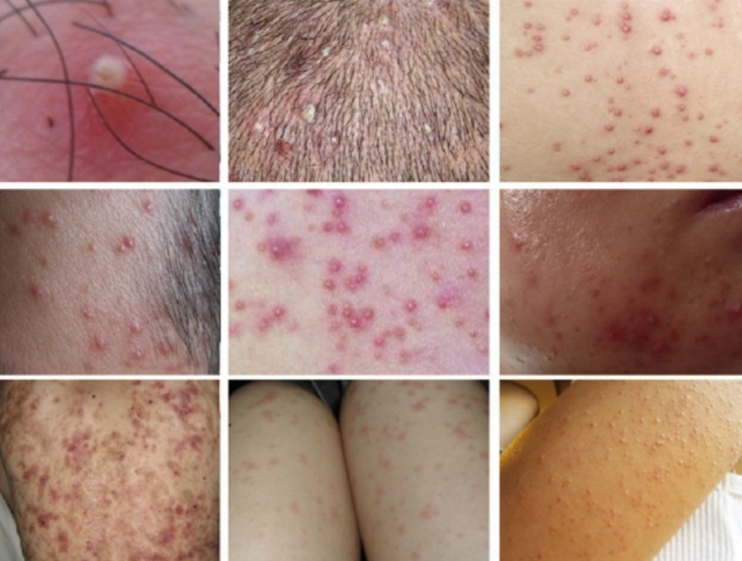 毛囊炎是什么原因引起的，一般跟这6个诱因有关，引发毛囊炎的早期6个原因