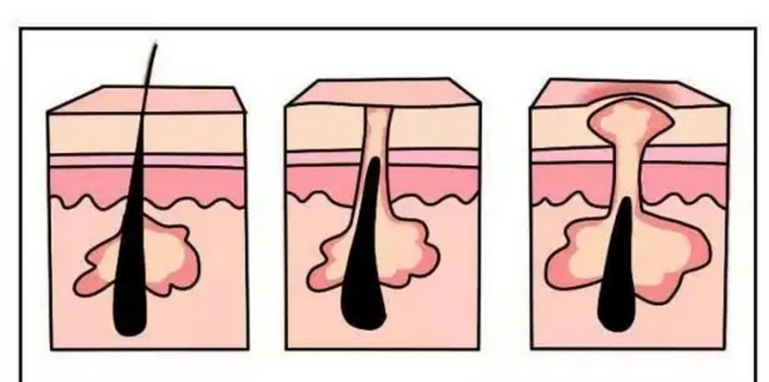 毛囊炎治疗攻略！整理的三种治疗发各有不同