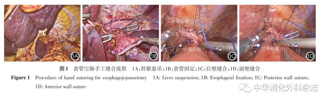 端端吻合器是什么菁英论坛｜完全腹腔镜全胃切除食管空肠吻合手术方式选择思考：手工缝合与器械吻合的碰撞与融合——邱江锋 曹晖_https://www.jmylbn.com_新闻资讯_第5张