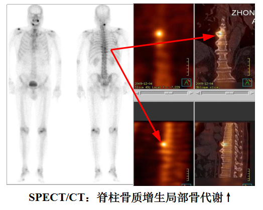 d-spect怎么检查【广中医讲堂】“核”您一起，了解核医学科“核武器”——SPECT／CT检查！_https://www.jmylbn.com_新闻资讯_第6张