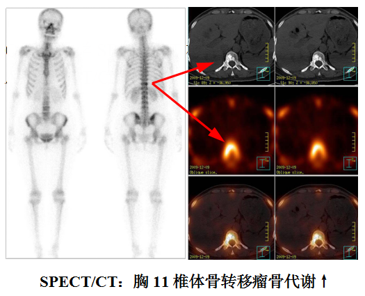 d-spect怎么检查【广中医讲堂】“核”您一起，了解核医学科“核武器”——SPECT／CT检查！_https://www.jmylbn.com_新闻资讯_第5张