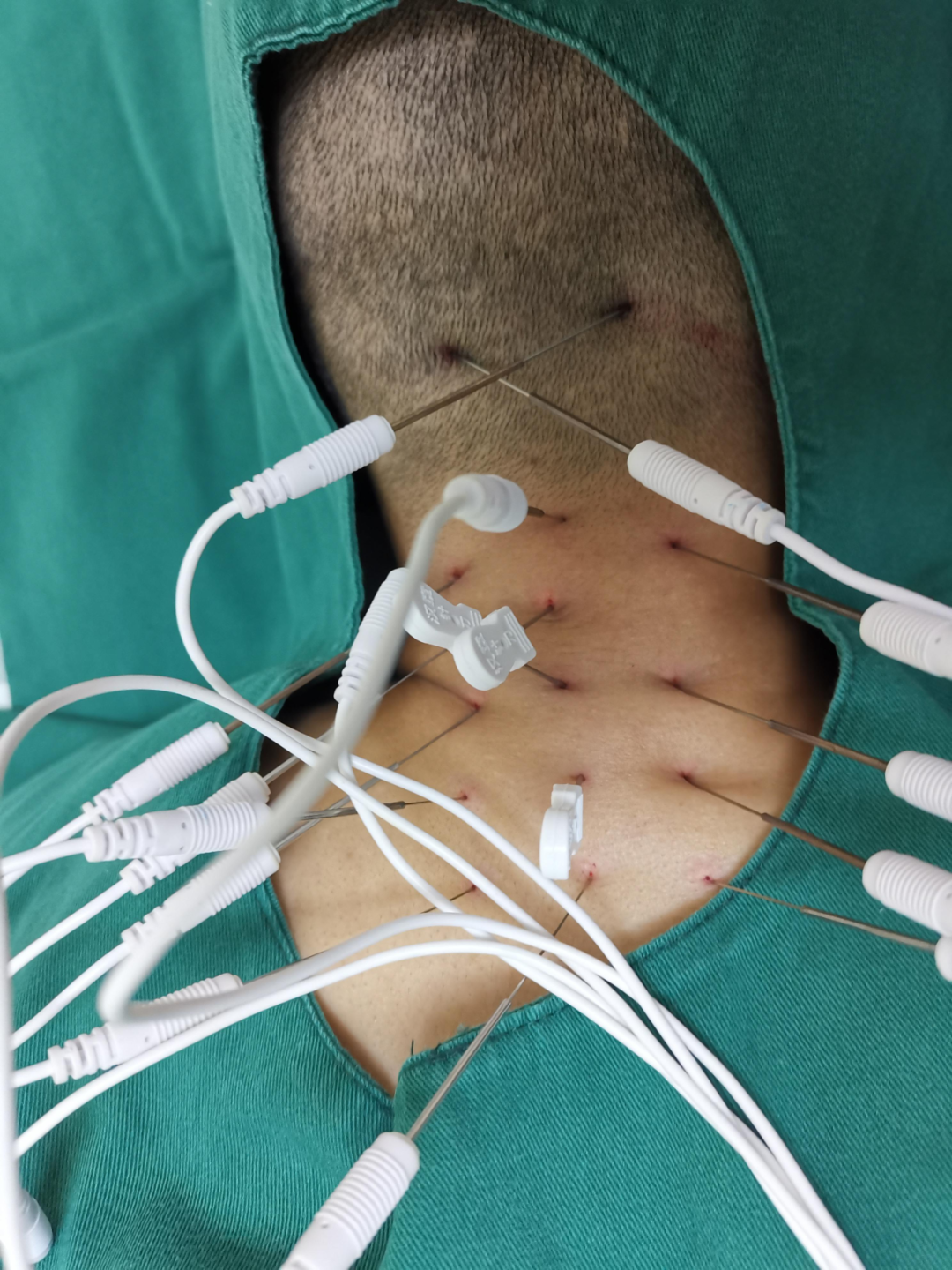 手术刀怎么消毒【特色技法④】内热针疗法：专治慢性顽固疼痛，中医“手术刀”远近期镇痛效力俱佳_https://www.jmylbn.com_新闻资讯_第28张