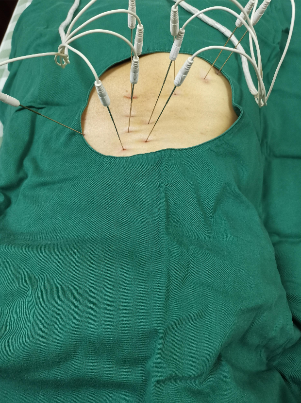 手术刀怎么消毒【特色技法④】内热针疗法：专治慢性顽固疼痛，中医“手术刀”远近期镇痛效力俱佳_https://www.jmylbn.com_新闻资讯_第29张