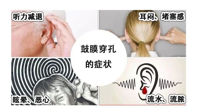 耳鼻喉内镜是什么科2024新技术新项目｜鼓膜穿孔怎么办？耳鼻喉科微创内镜来修补_https://www.jmylbn.com_新闻资讯_第14张