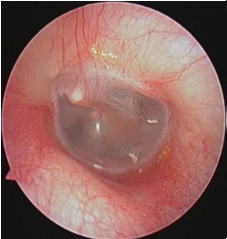 耳鼻喉内镜是什么科2024新技术新项目｜鼓膜穿孔怎么办？耳鼻喉科微创内镜来修补_https://www.jmylbn.com_新闻资讯_第11张
