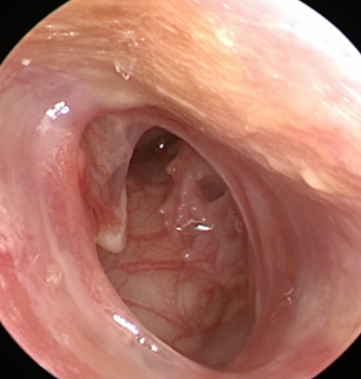 耳鼻喉内镜是什么科2024新技术新项目｜鼓膜穿孔怎么办？耳鼻喉科微创内镜来修补_https://www.jmylbn.com_新闻资讯_第12张