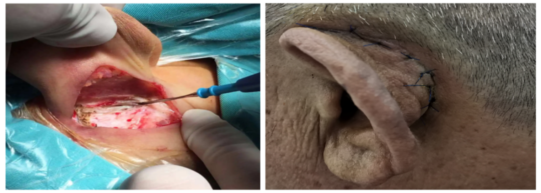 耳鼻喉内镜是什么科2024新技术新项目｜鼓膜穿孔怎么办？耳鼻喉科微创内镜来修补_https://www.jmylbn.com_新闻资讯_第6张