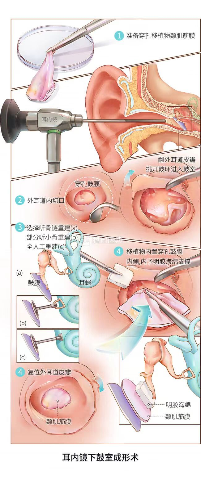 耳鼻喉内镜是什么科2024新技术新项目｜鼓膜穿孔怎么办？耳鼻喉科微创内镜来修补_https://www.jmylbn.com_新闻资讯_第8张