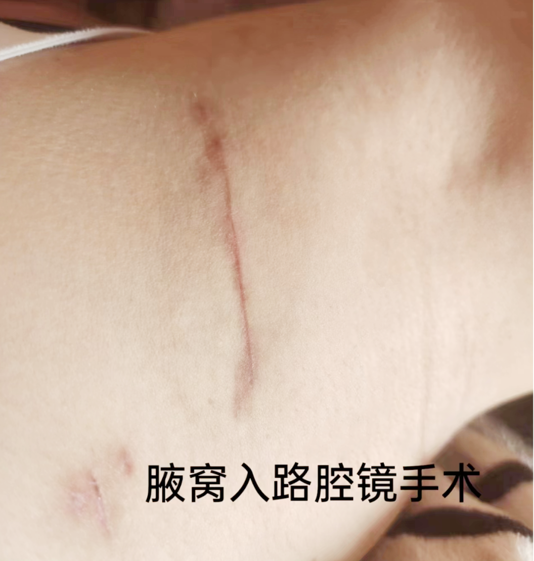 传统的甲状腺手术切口位于颈前正中位置,术后瘢痕明显,不仅对于爱美