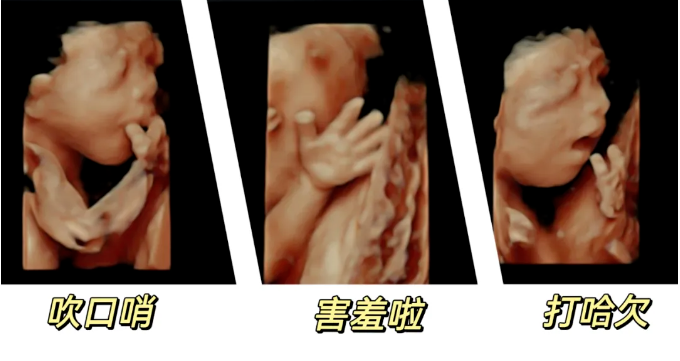 汕头彩超怎么样NT检查、四维大排畸、孕晚期四维小排畸能互相取代吗？「汕头妇产科医院」_https://www.jmylbn.com_新闻资讯_第6张