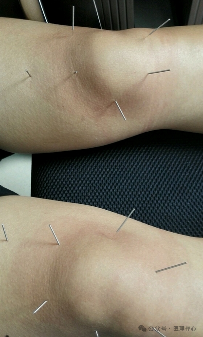 膝盖积液、滑膜炎、半月板损伤用什么药？中药治疗方案详解