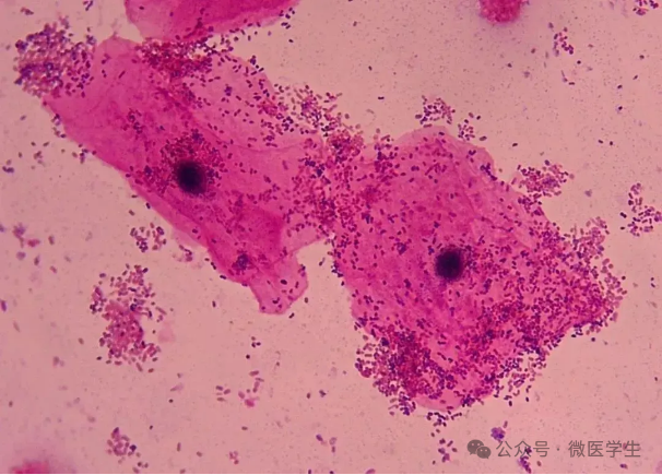 上皮细胞用什么染色什么是“线索细胞”？_https://www.jmylbn.com_新闻资讯_第3张