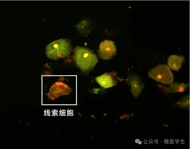 上皮细胞用什么染色什么是“线索细胞”？_https://www.jmylbn.com_新闻资讯_第4张