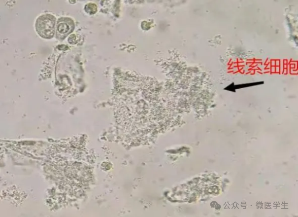 上皮细胞用什么染色什么是“线索细胞”？_https://www.jmylbn.com_新闻资讯_第2张
