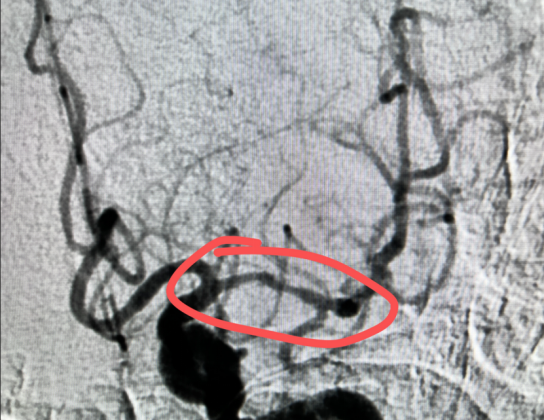 男子春节急发脑卒中，多学科抢救化险为夷！