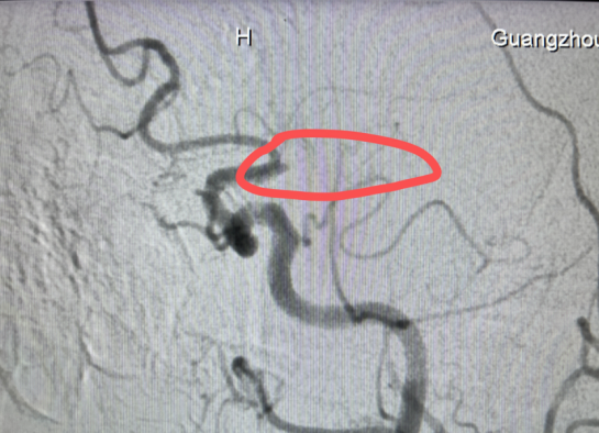 男子春节急发脑卒中，多学科抢救化险为夷！