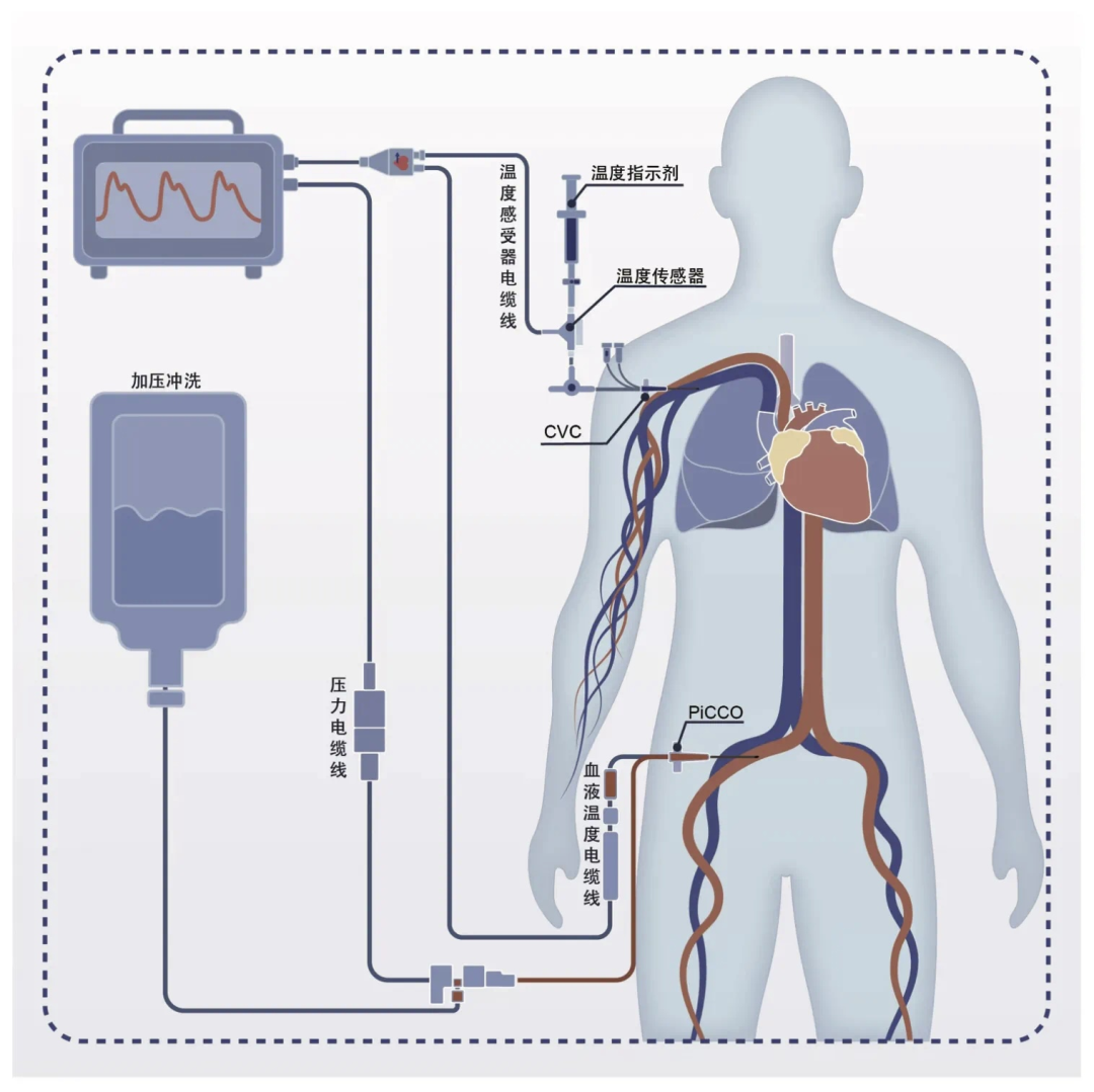 麻醉监测仪有哪些【麻醉监护设备】为生命护航的科技力量_https://www.jmylbn.com_新闻资讯_第15张