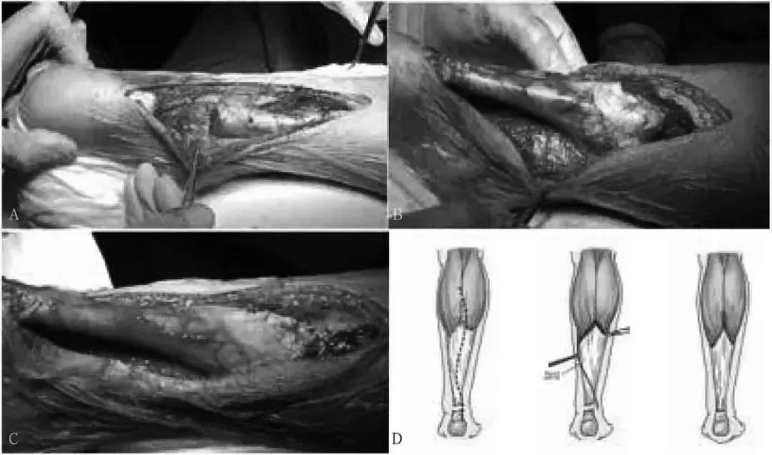 缝合器都有哪些厂家跟腱断裂常用的四种缝合修复方法，你都知道吗？_https://www.jmylbn.com_新闻资讯_第7张