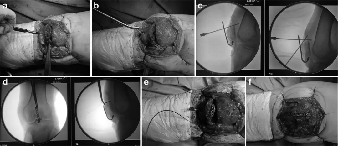 扎骨针怎么装髌骨下极粉碎骨折怎么办？7种固定技术详解与术式选择_https://www.jmylbn.com_新闻资讯_第2张
