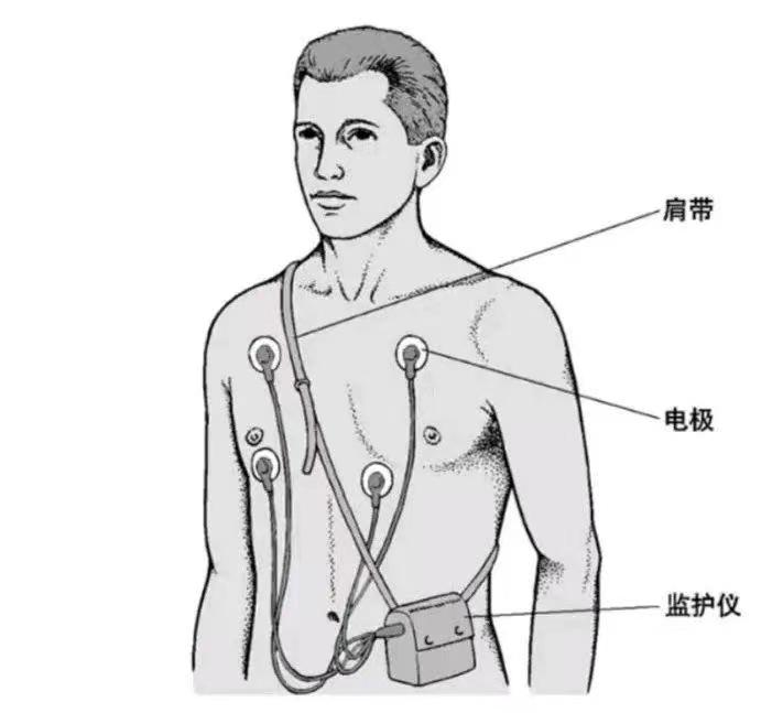 动态心电图仪器怎么看【新技术】动态心电图检查_https://www.jmylbn.com_新闻资讯_第3张