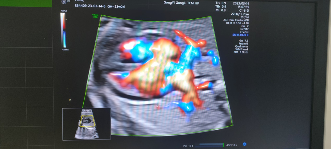 ge彩超怎么样康达医院引进国际领先金标版GE-E10四维彩超  提升我县妇幼健康服务能力_https://www.jmylbn.com_新闻资讯_第20张