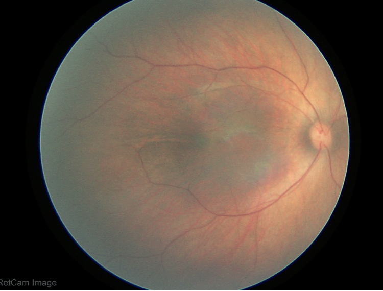 医院仪器怎么成像【资讯】国内率先使用！小儿眼底筛查智能化再进一步_https://www.jmylbn.com_新闻资讯_第7张