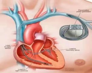 心脏是怎么固定的仁医新术｜江西省心血管病医院完成省内首例主动固定式左室四极电极导线植入_https://www.jmylbn.com_新闻资讯_第6张