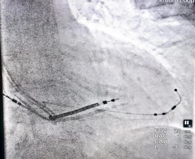 心脏是怎么固定的仁医新术｜江西省心血管病医院完成省内首例主动固定式左室四极电极导线植入_https://www.jmylbn.com_新闻资讯_第5张