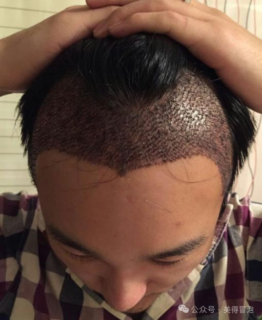 男性发际线种植，各区域毛囊密度如何分布？