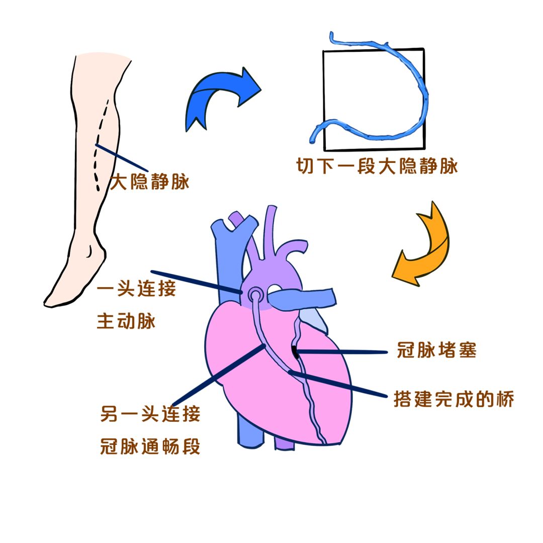 我院心脏外科为高龄重症患者实施冠状动脉搭桥术